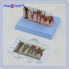 PNT-0528ad Osteoporose educacional Modelo de dentes dentais doentes